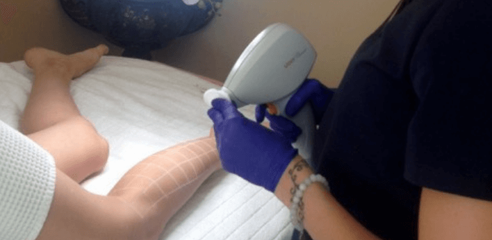 Depilacja laserowa nóg – ile zabiegów należy wykonać?